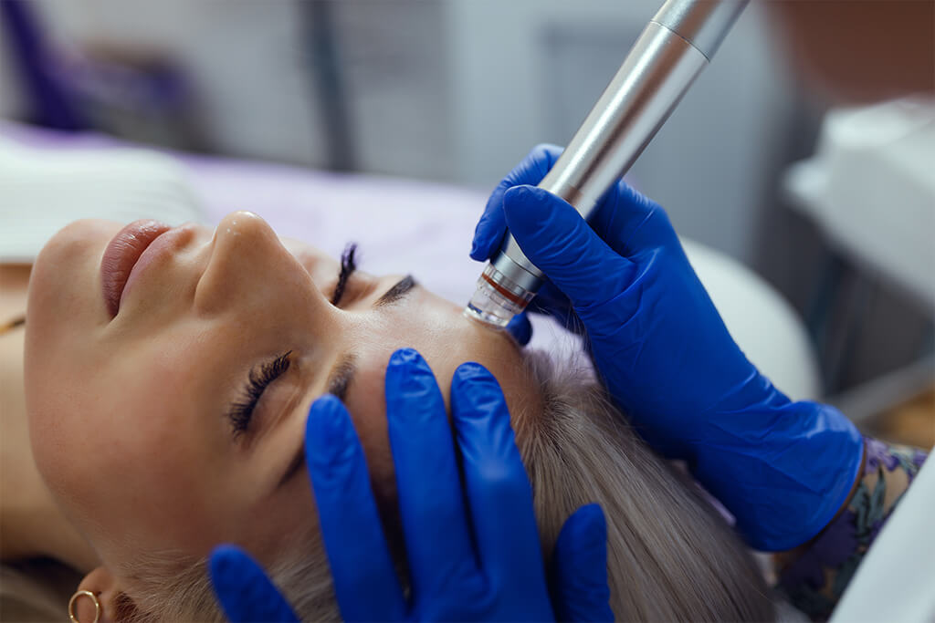 Microdermoabrasión - beneficios que trae para su rostro