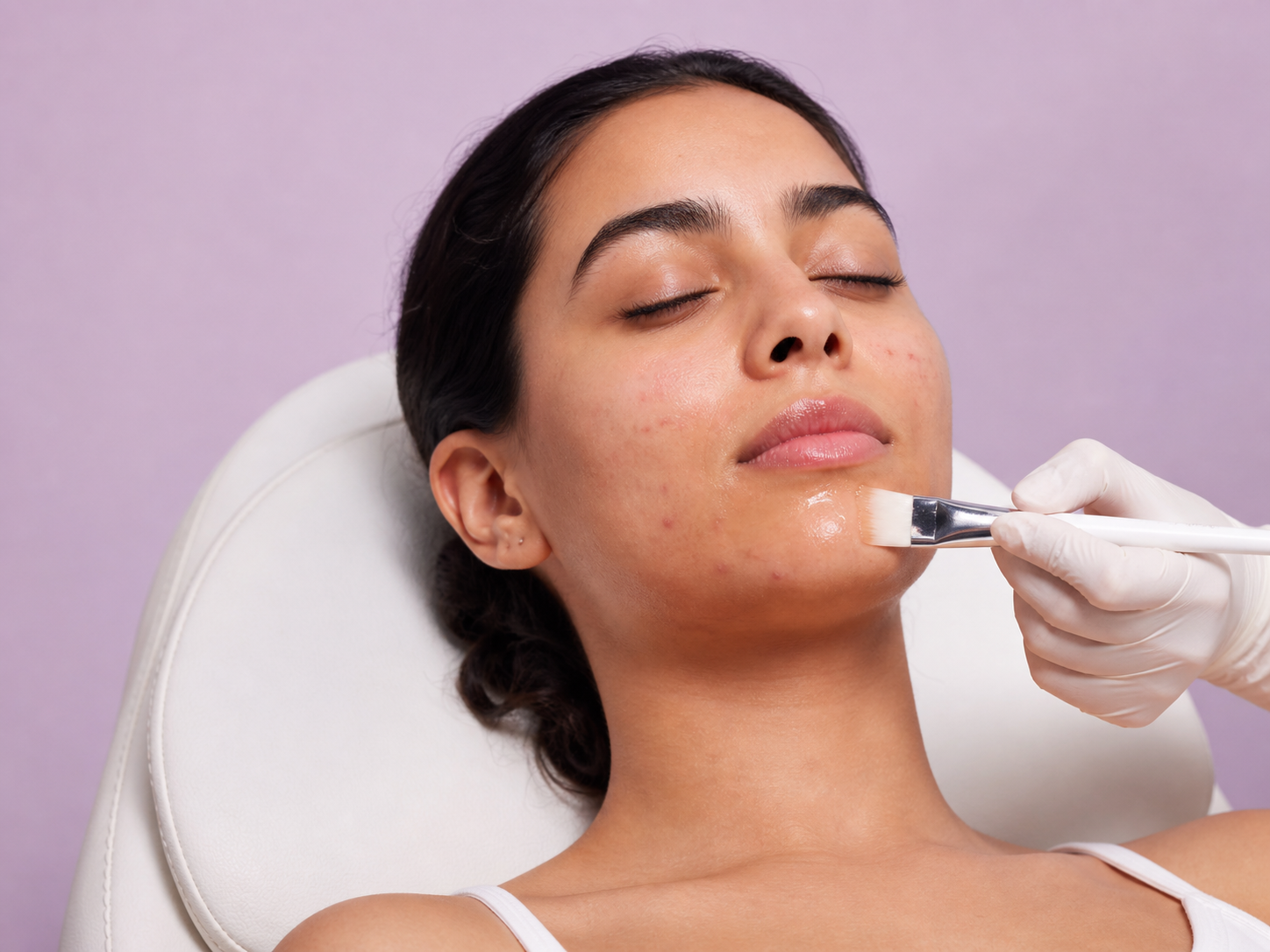 Anti-Acne