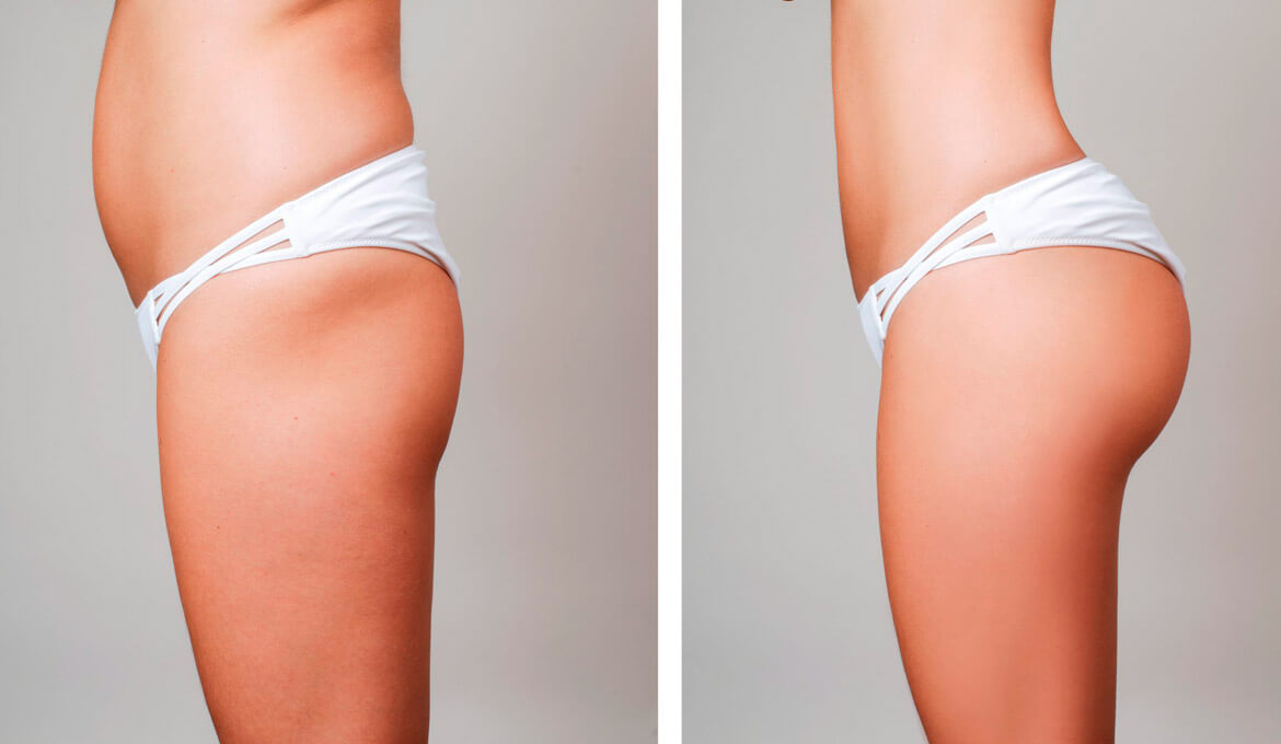 Body shaping techniques: BodyTite
