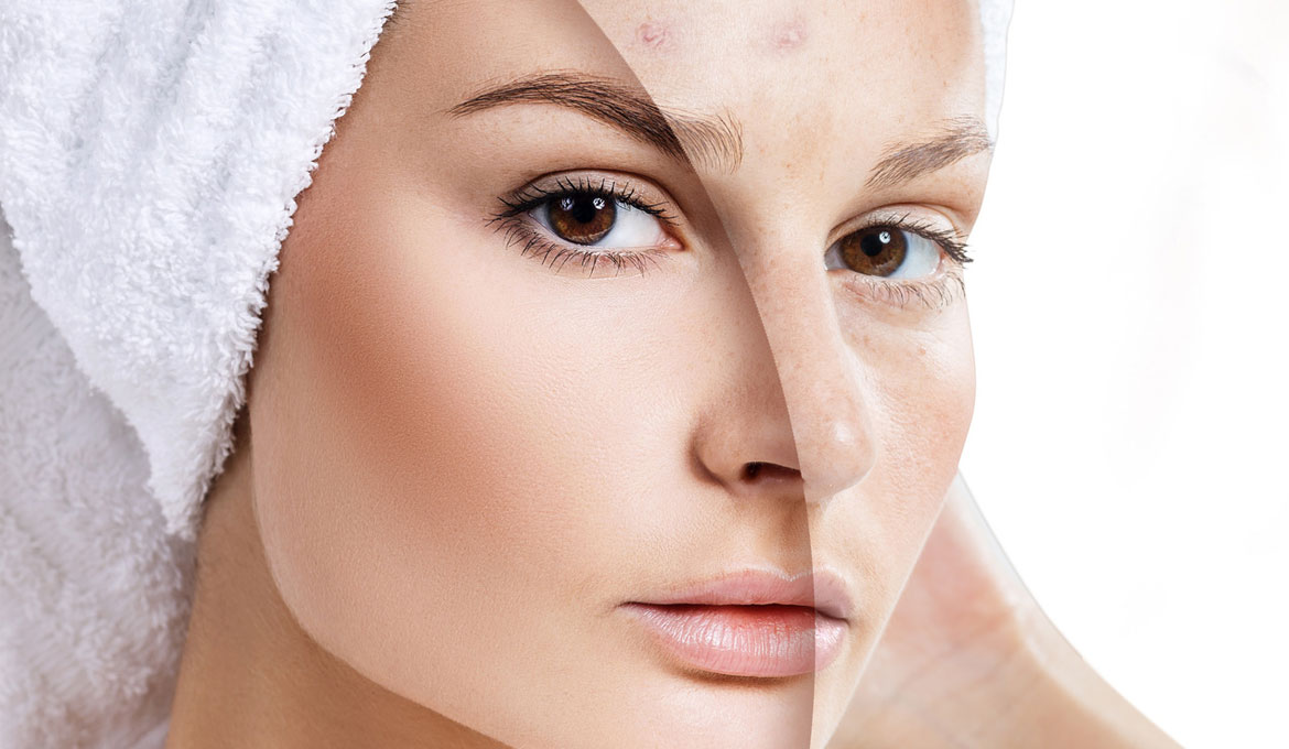 Cosmelan – the treatment to remove stains