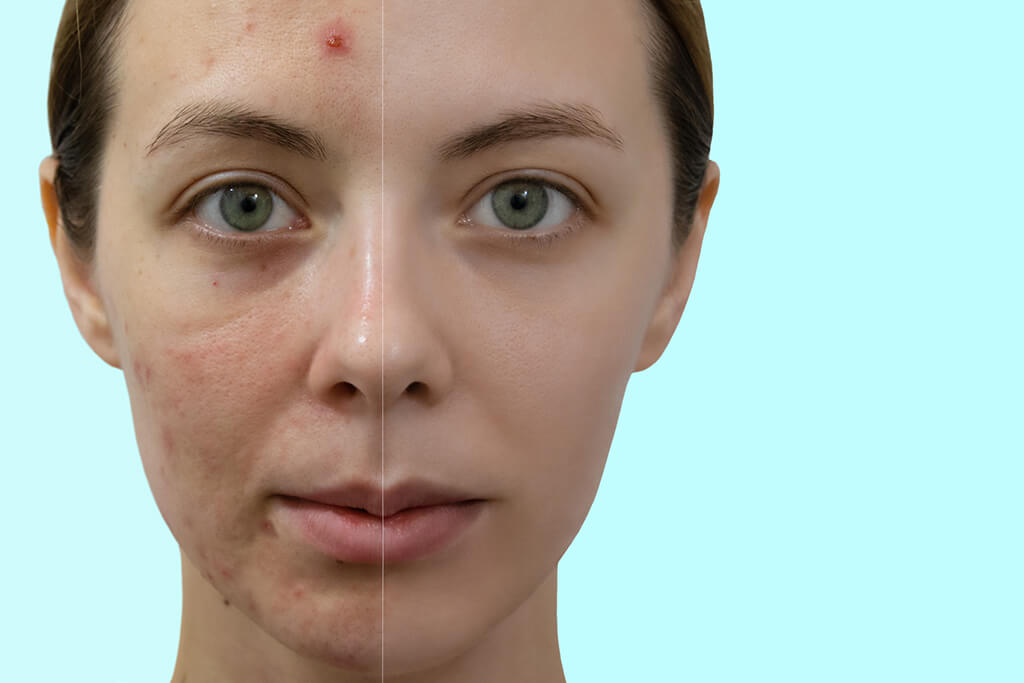 Cómo se pueden tratar o reducir las marcas del acné del rostro