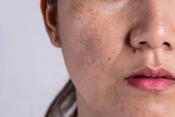 Elimine manchas del rostro
